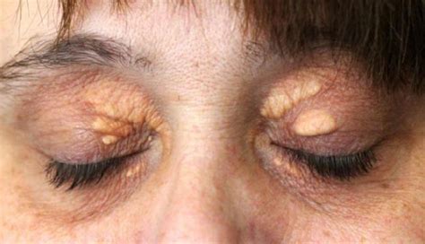 Memahami Xanthelasma Bercak Di Kelopak Mata Akibat Penumpukan