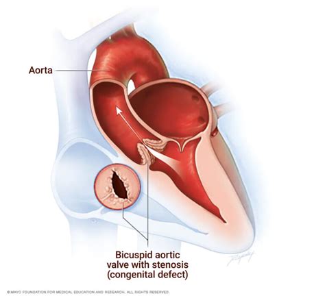 Bicuspid Aortic Valve Syndrome Signs Symptoms Marfan Foundation