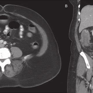 A Axial View Abdominal Ct Showing Classical Target Sign Arrow Of