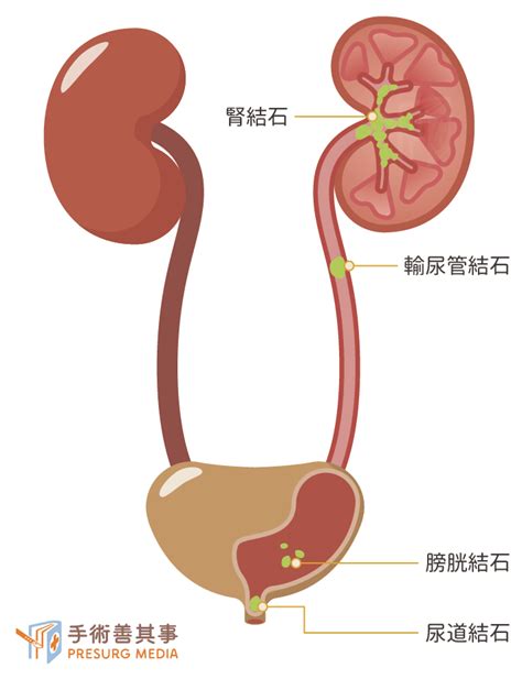 腎結石症狀有哪些？腎結石原因、症狀、治療、飲食一次看