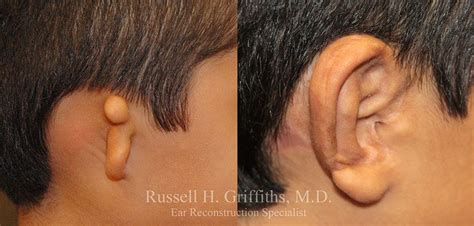 Microtia Surgery - Russell H. Griffiths, MD