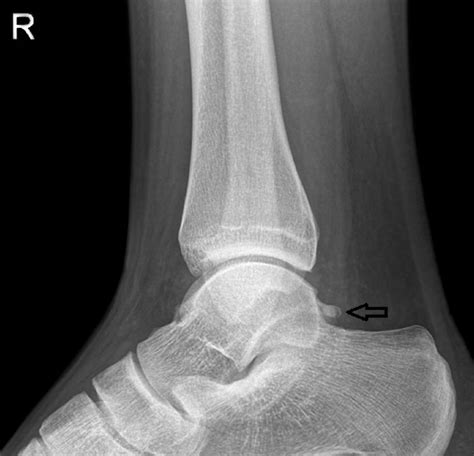 Previous Lateral X Ray Of Right Ankle Before Injury Lateral Ankle Download Scientific Diagram