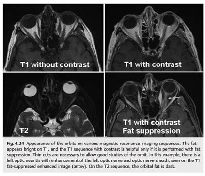 Neuro Ophthalmology Question Of The Week Magnetic Resonance Imaging