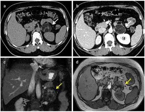 Diagnostics Free Full Text Adrenal Lesions A Review Of Imaging