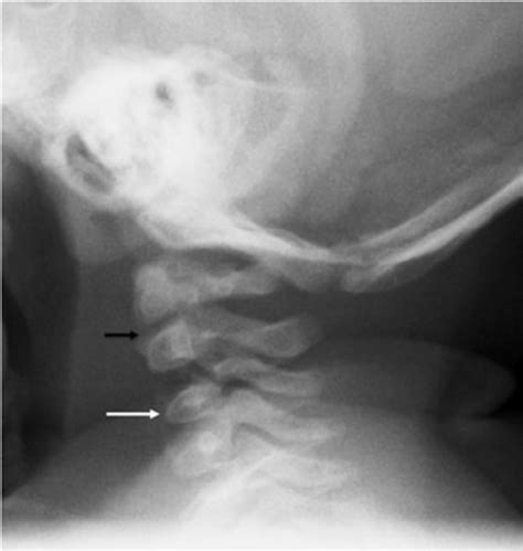 Lateral Cervical Spine Radiograph In A 2 Month Old Girl Shows Wedging