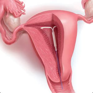 The IUD string check: Benefit or burden? | MDedge ObGyn