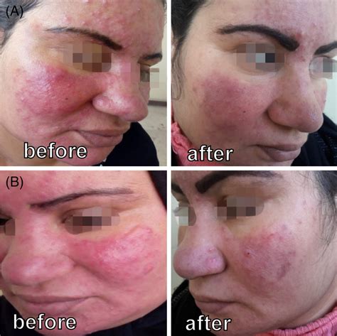 Group A 28‐year Female Patient With Severe Papulopustular Rosacea Download Scientific