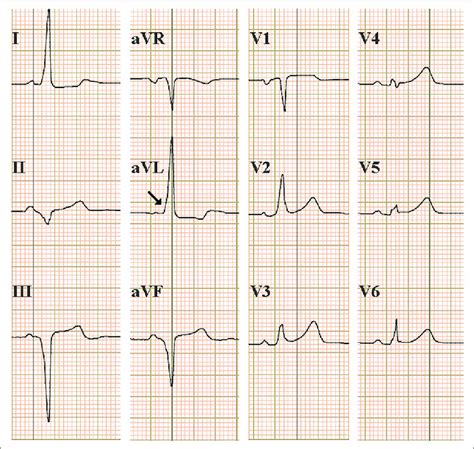 B Wolff Parkinson White Wpw Syndrome Type B St Emlyn S Hot Sex Picture