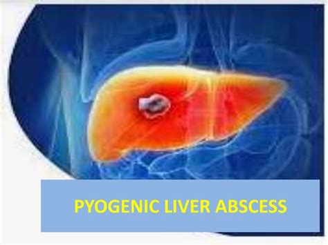 Pyogenic Liver Abscesspptx