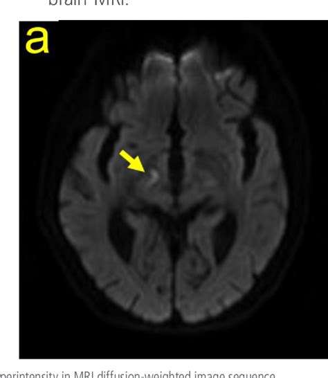 Figure From Comparison Of Hemichorea Hemiballism Between Acute Stroke