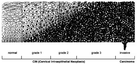 Schematic Representation Of Cervical Squamous Precursor Lesions