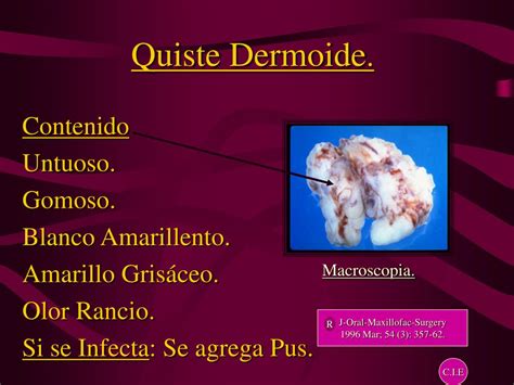 PPT Quistes Dermoides PowerPoint Presentation ID 425244