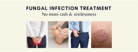 Fungal Infection Treatment in Delhi | Dr.Shruti Gupta MBBS, MD - SKINOS®