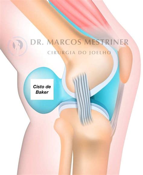 Cisto De Baker O Que É - Cisto de Baker: O Que É? Por Que Acontece? Como Resolver? - Dr. Marcos ...
