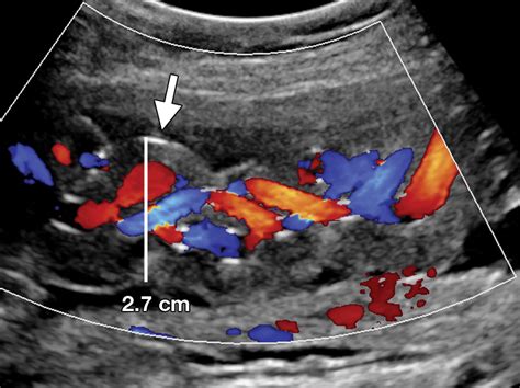 Comprehensive Imaging Review Of Abnormalities Of The Umbilical Cord Radiographics