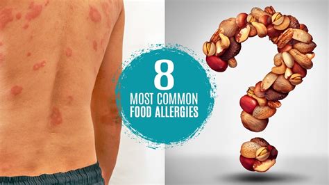 What Are The 8 Most Common Food Allergies Symptoms Treatment