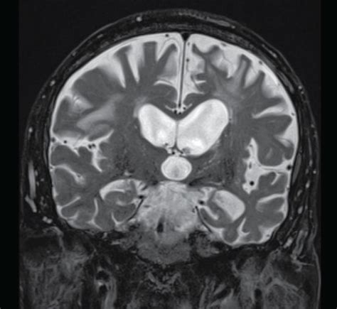 Overview Of Typical Mri Findings In Our Cases Asymmetrical Atrophy Of