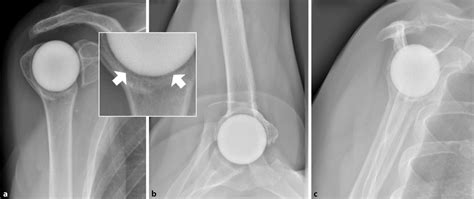 8 Postoperative Radiographs In The Anteroposterior A The Axial B