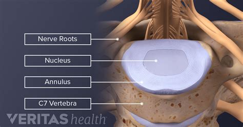 Cervical Discs