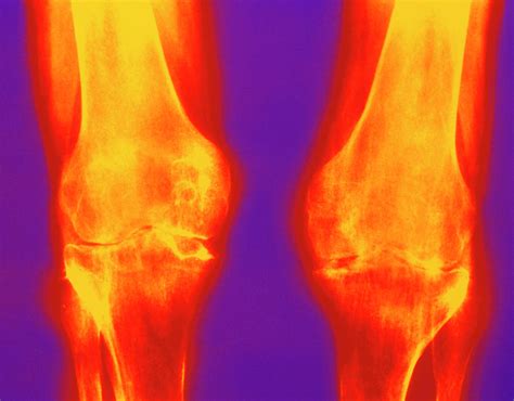 X-ray Of Rheumatoid Arthritis In Knees Photograph by Medical Photo Nhs ...