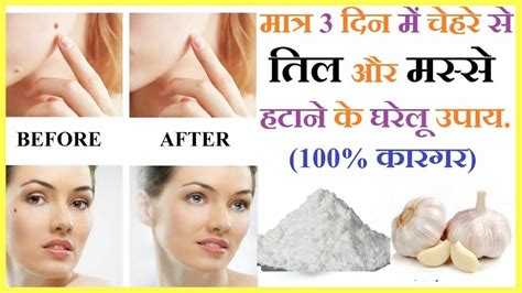 तिल और मस्से को जड़ से ख़त्म करने का सबसे अच्छा उपाय Remove Skin Tag