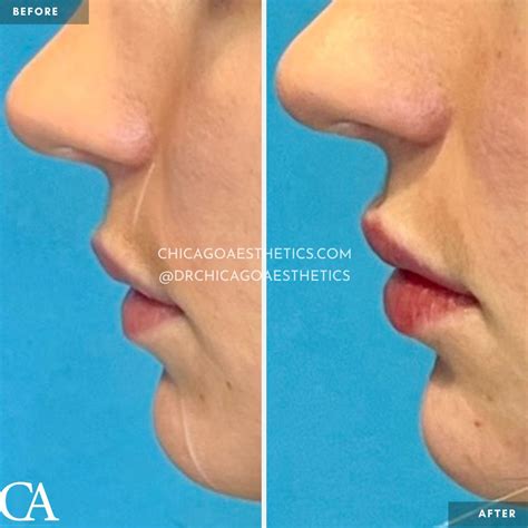 Lip Injections Before After Chicago Aesthetics Medspa