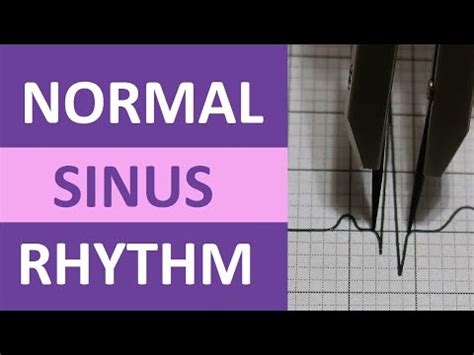 Normal Sinus Rhythm ECG/EKG Interpretation Quiz Questions