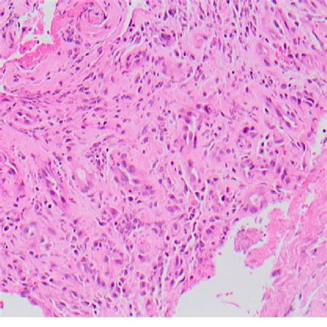 Histological Analysis Demonstrating A Score Of For The Presence Of