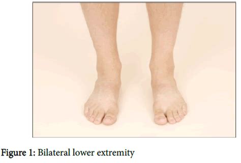 A Rare Finding of Symptomatic Bilateral Lower Extremity Hernia