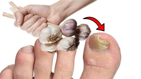 How To Get Rid Of Nail Fungus Using Garlic Youtube