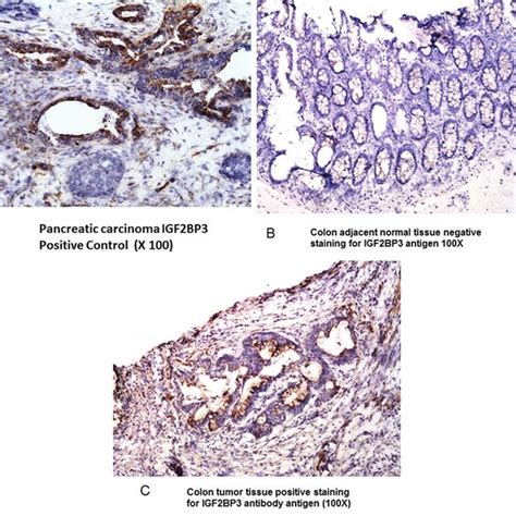 A Immunohistochemistry Ihc Staining Of Pancreatic Carcinoma Positive