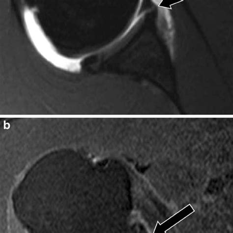 Anterior Labral Tear Shoulder