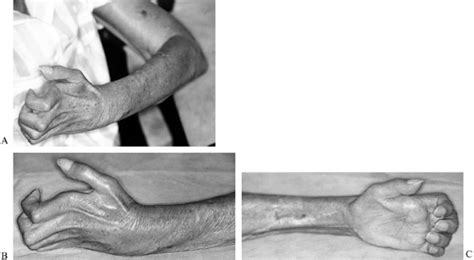 MANAGEMENT OF VOLKMANN'S CONTRACTURE - TeachMe Orthopedics