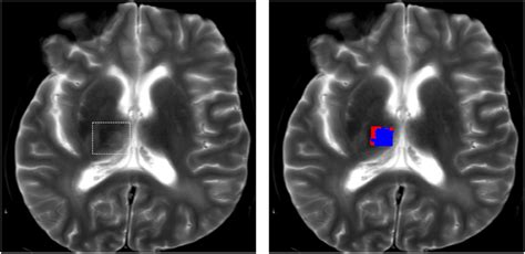 Transcranial Histotripsy Clot And Tissue Ablation For Intracerebral