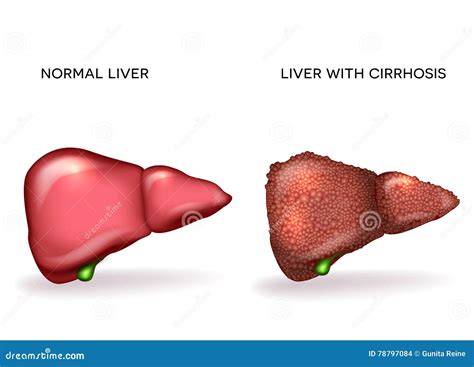 Hígado Sano Normal Y Hígado Con Cirrosis Ilustración del Vector