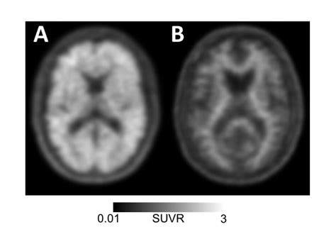 An Amyoid Pet Scan Can Detect Alzheimers—but Its Not Covered By