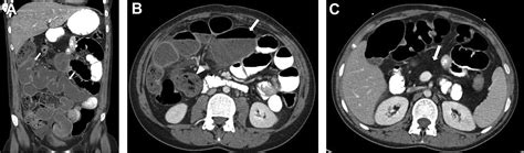 Neonatal And Pediatric Bowel Obstruction Radiology Key