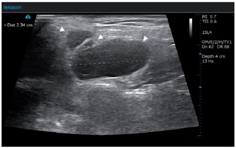 Figure 1 From Ultrasound Guided Ethanol Sclerotherapy For Multifocal