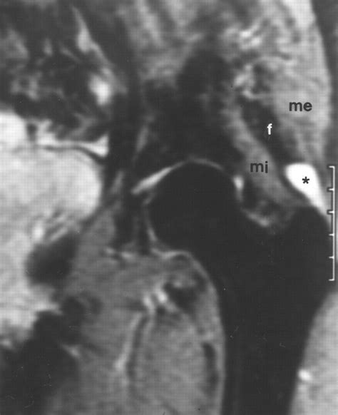 Mri Diagnosis Of Tears Of The Hip Abductor Tendons Gluteus Medius And Gluteus Minimus Ajr