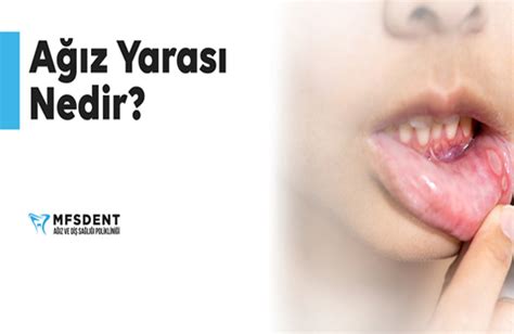 Ağız Yarası Neden Olur ve Nasıl Geçer Ağız Yarası İlaçları