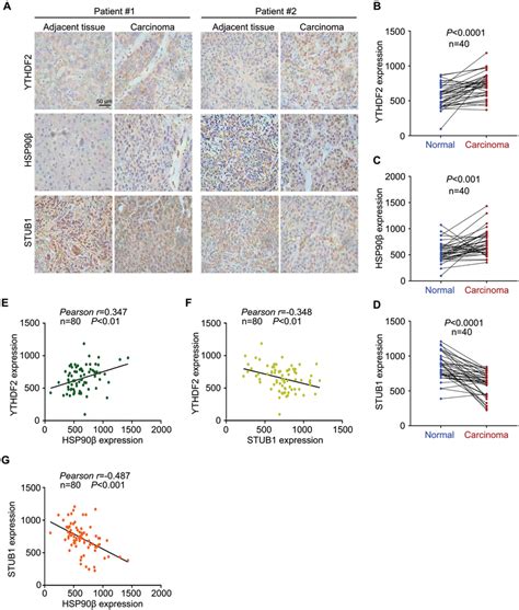 Clinical relationship of YTHDF2 HSP90β and STUB1 in HCC tissues A