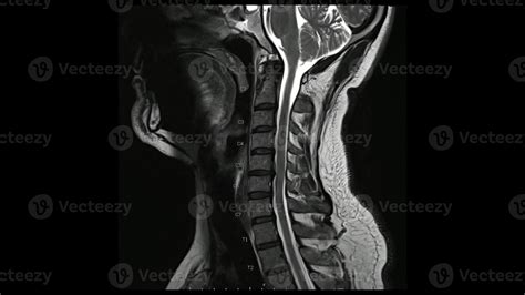 Magnetic Resonance Images Of Cervical Spine Sagittal T Weighted Image