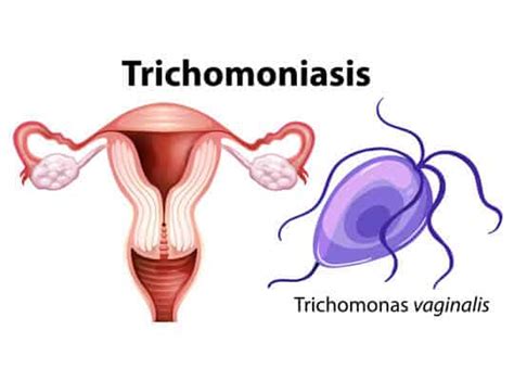 Trichomonas Vaginalis Project Healthcare