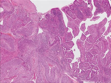 Contiguous Squamous Proliferations In Syringocystadenoma Papilliferum