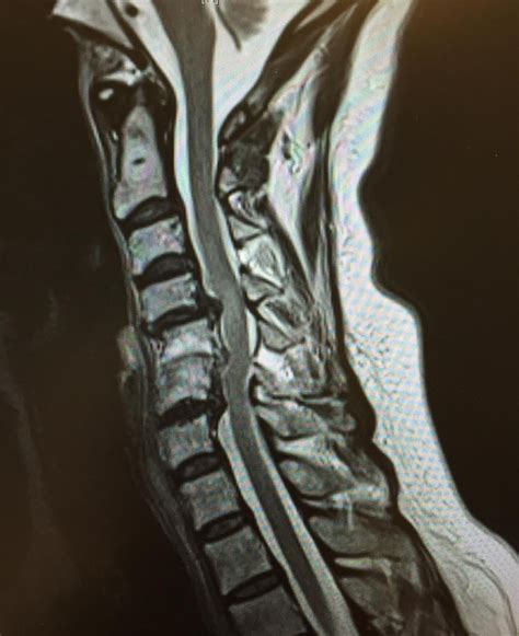 Cervical Myelopathy Spine Orthobullets