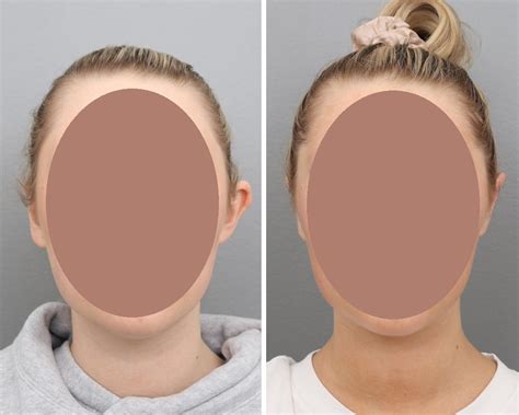 Facial Plastic Surgery Before And After Photos Gold Coast Plastic Surgery