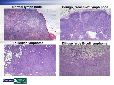 Ppt Lymphoma Overview Powerpoint Presentation Free Download Id4501266