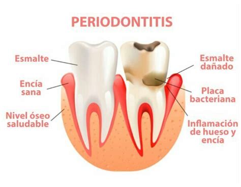 Periodontitis S Ntomas Causas Y Tratamiento Cl Nica Dental Provenza