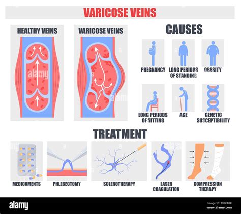 Varicose Vein Causes And Treatment Medical Poster Stock Vector Image