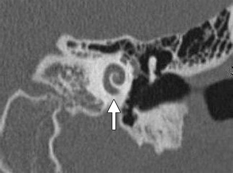 Ct And Mr Imaging Of The Inner Ear And Brain In Children With